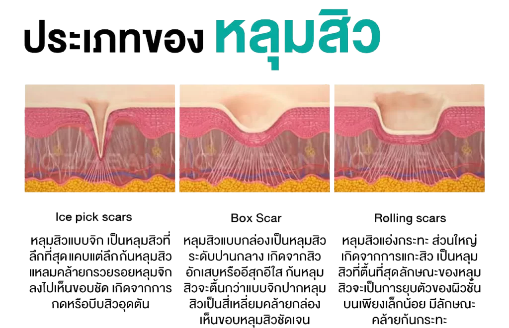 ประเภทของหลุมสิวที่สามารถใช้การทำ Subcision