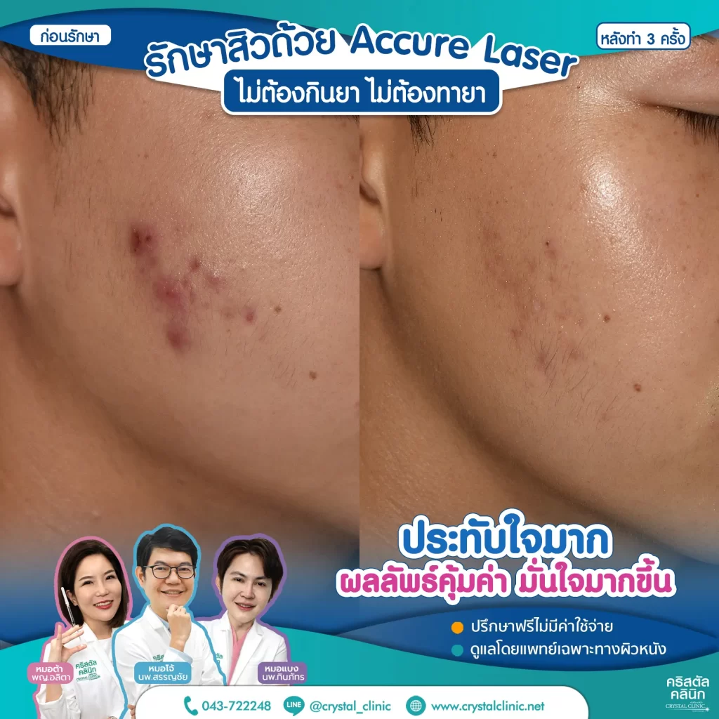 5511175-Accure-หลังทำ-3-ครั้ง_1-1024x1024