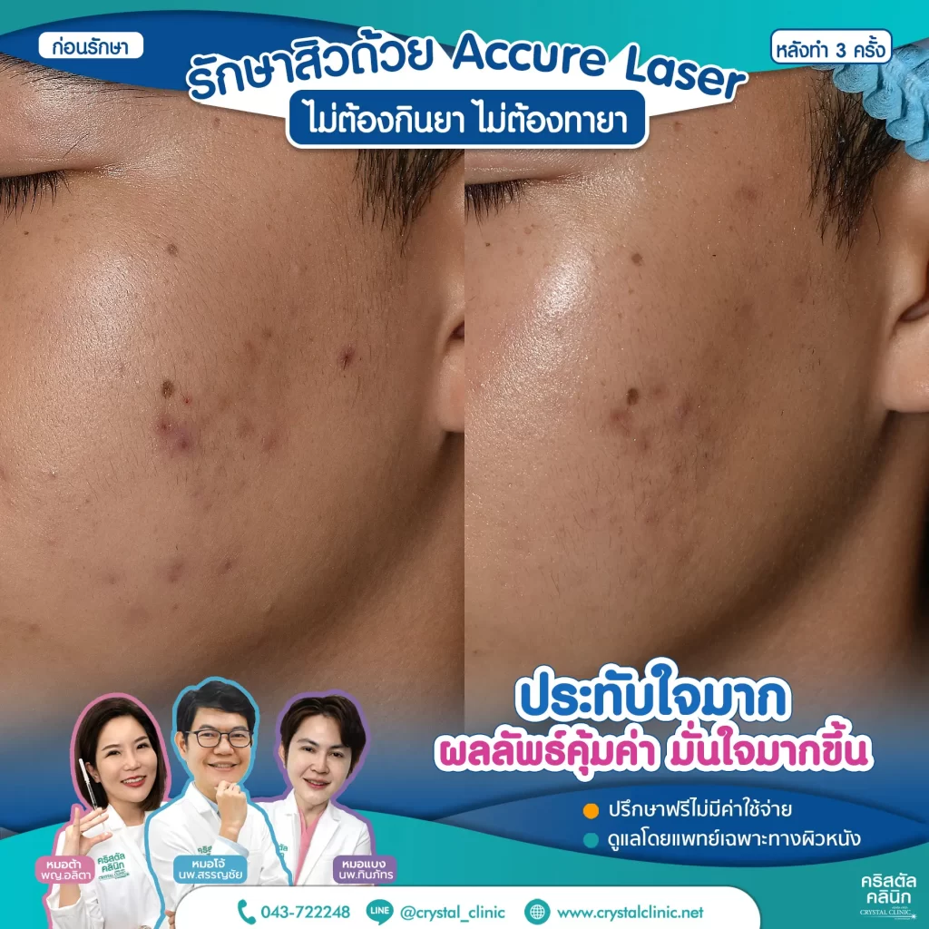 5511175-Accure-หลังทำ-3-ครั้ง_2-1024x1024