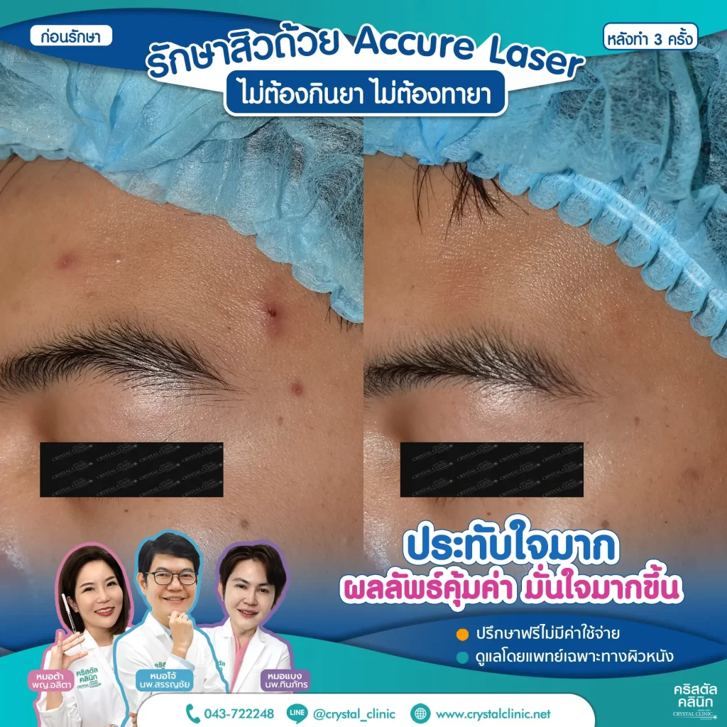 5511175-Accure-หลังทำ-3-ครั้ง_3-1024x1024