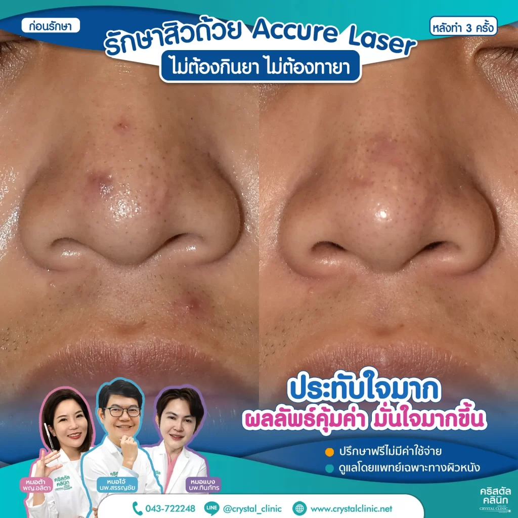 5511175-Accure-หลังทำ-3-ครั้ง_4-1024x1024