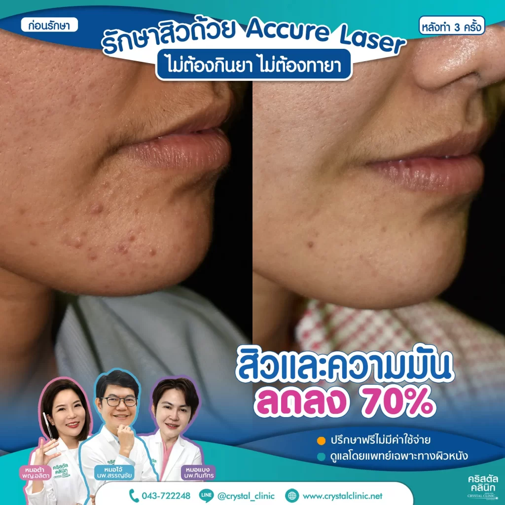 6008114-Accure-Laser-หลังทำ-3-ครั้ง_1-1024x1024