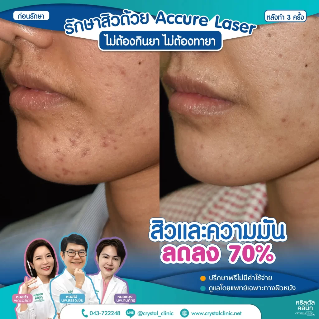 6008114-Accure-Laser-หลังทำ-3-ครั้ง_2-1024x1024