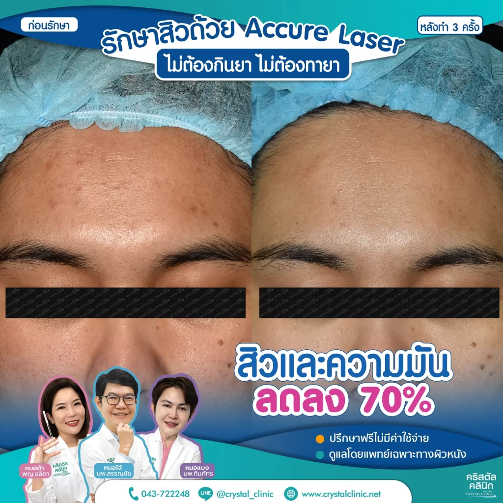 6008114-Accure-Laser-หลังทำ-3-ครั้ง_3-1024x1024