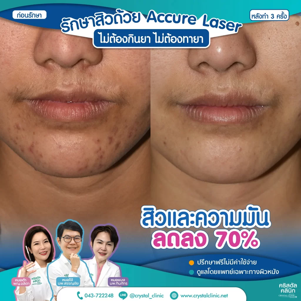 6008114-Accure-Laser-หลังทำ-3-ครั้ง_4-1024x1024