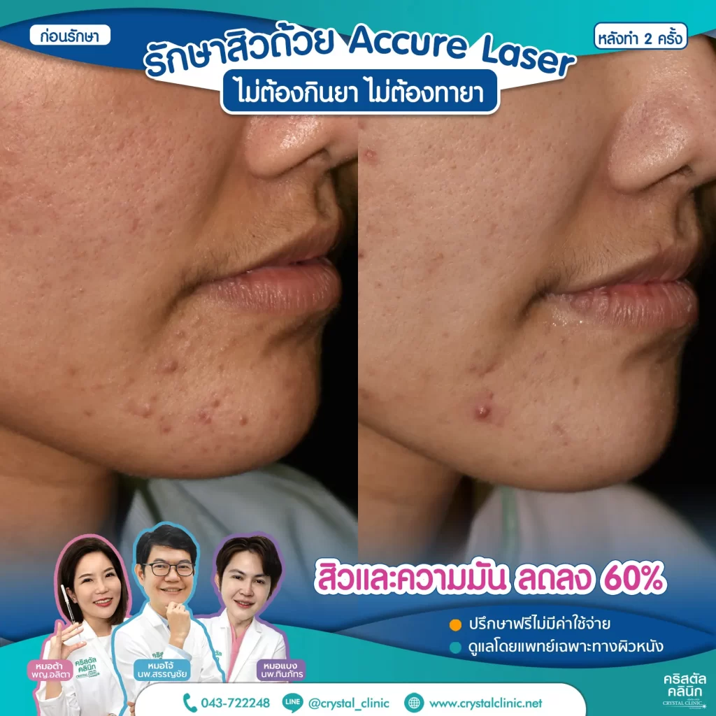 6008114_Accure-Laser-หลังทำ-2-ครั้ง_1-1024x1024