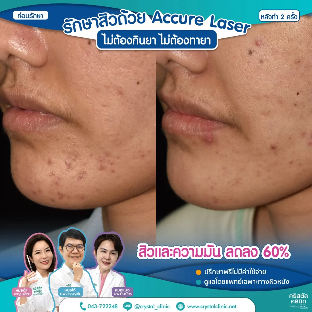 6008114_Accure-Laser-หลังทำ-2-ครั้ง_3-1024x1024