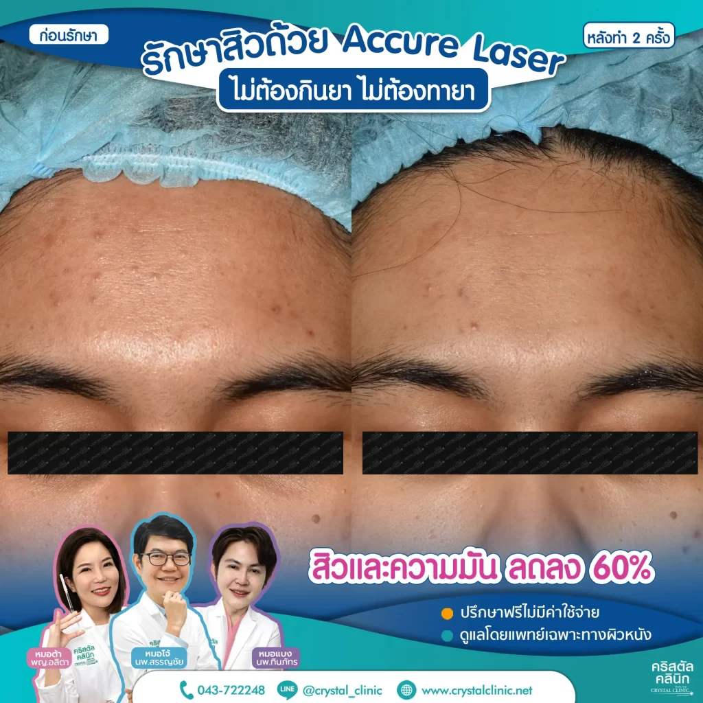 6008114_Accure-Laser-หลังทำ-2-ครั้ง_5-1024x1024