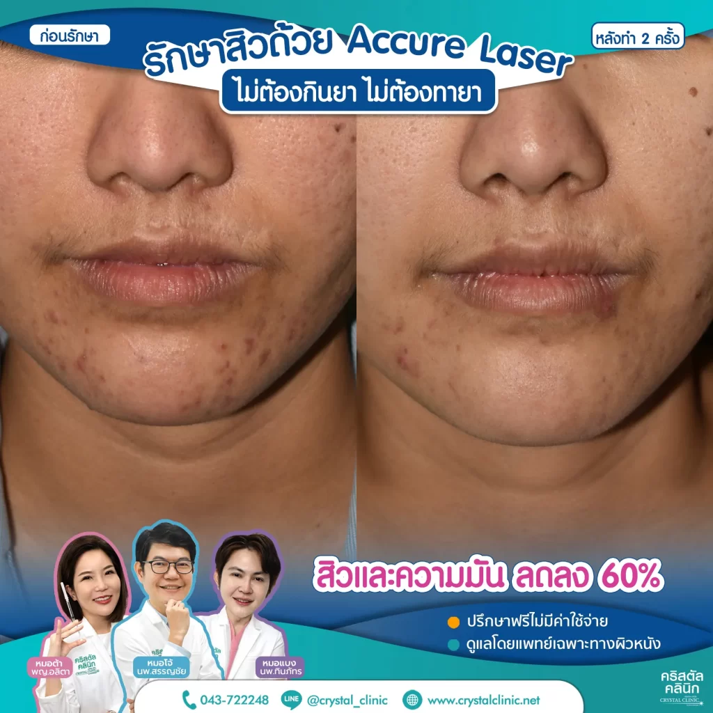 6008114_Accure-Laser-หลังทำ-2-ครั้ง_6-1024x1024