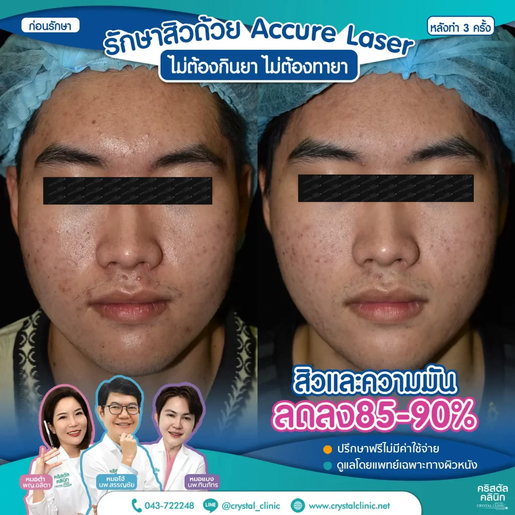 6606114_Accure-Laser-หลังทำ-3-ครั้ง_1-1024x1024