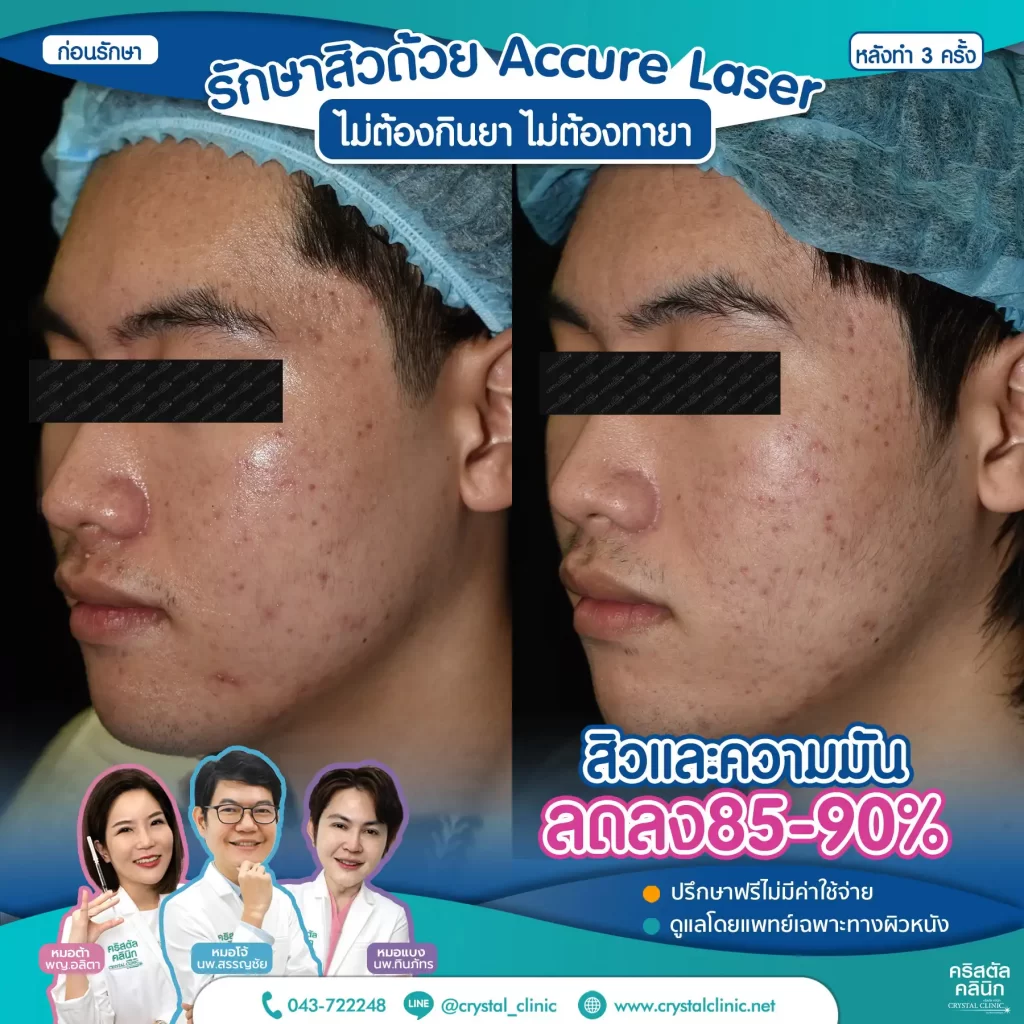 6606114_Accure-Laser-หลังทำ-3-ครั้ง_2-1024x1024
