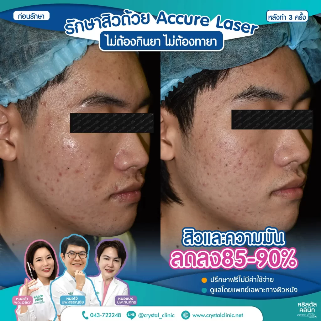 6606114_Accure-Laser-หลังทำ-3-ครั้ง_3-1024x1024