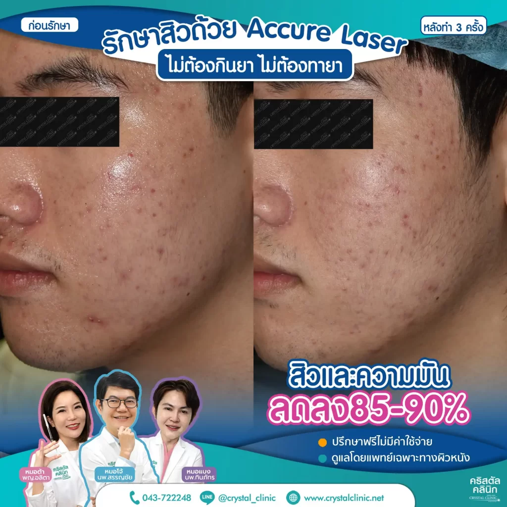 6606114_Accure-Laser-หลังทำ-3-ครั้ง_4-1024x1024