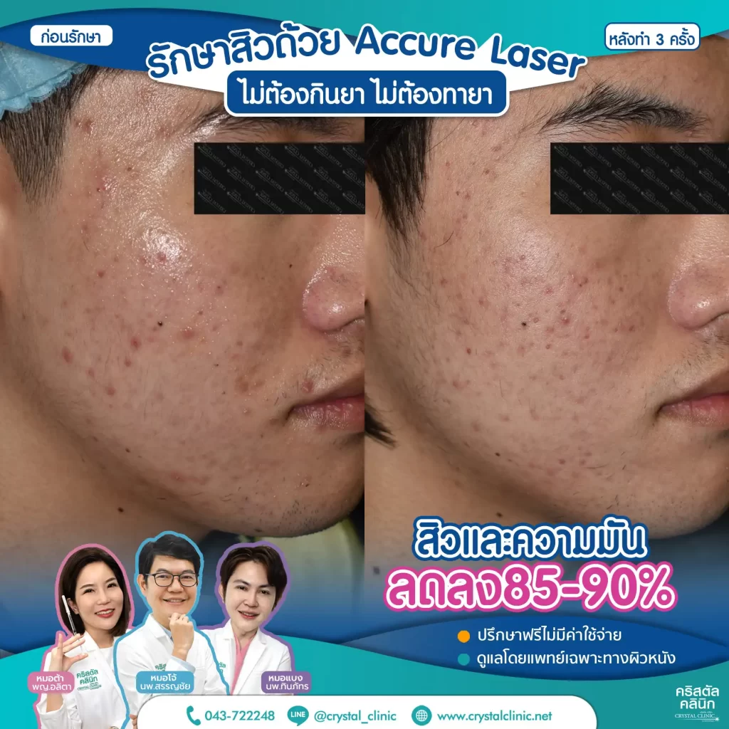 6606114_Accure-Laser-หลังทำ-3-ครั้ง_5-1024x1024