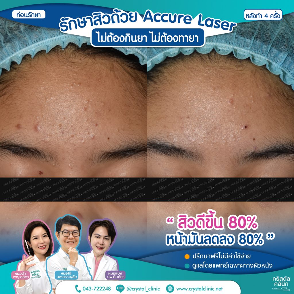 6610064-Accure-Laser-หลังทำ-4-ครั้ง_2-1024x1024