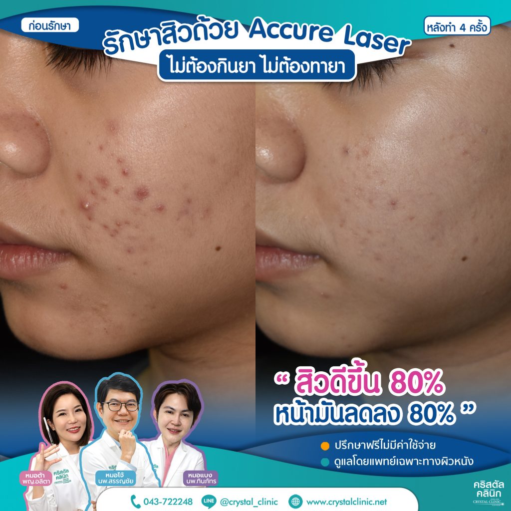 6610064-Accure-Laser-หลังทำ-4-ครั้ง_3-1024x1024