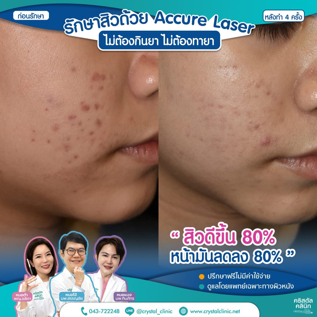 6610064-Accure-Laser-หลังทำ-4-ครั้ง_4-1024x1024