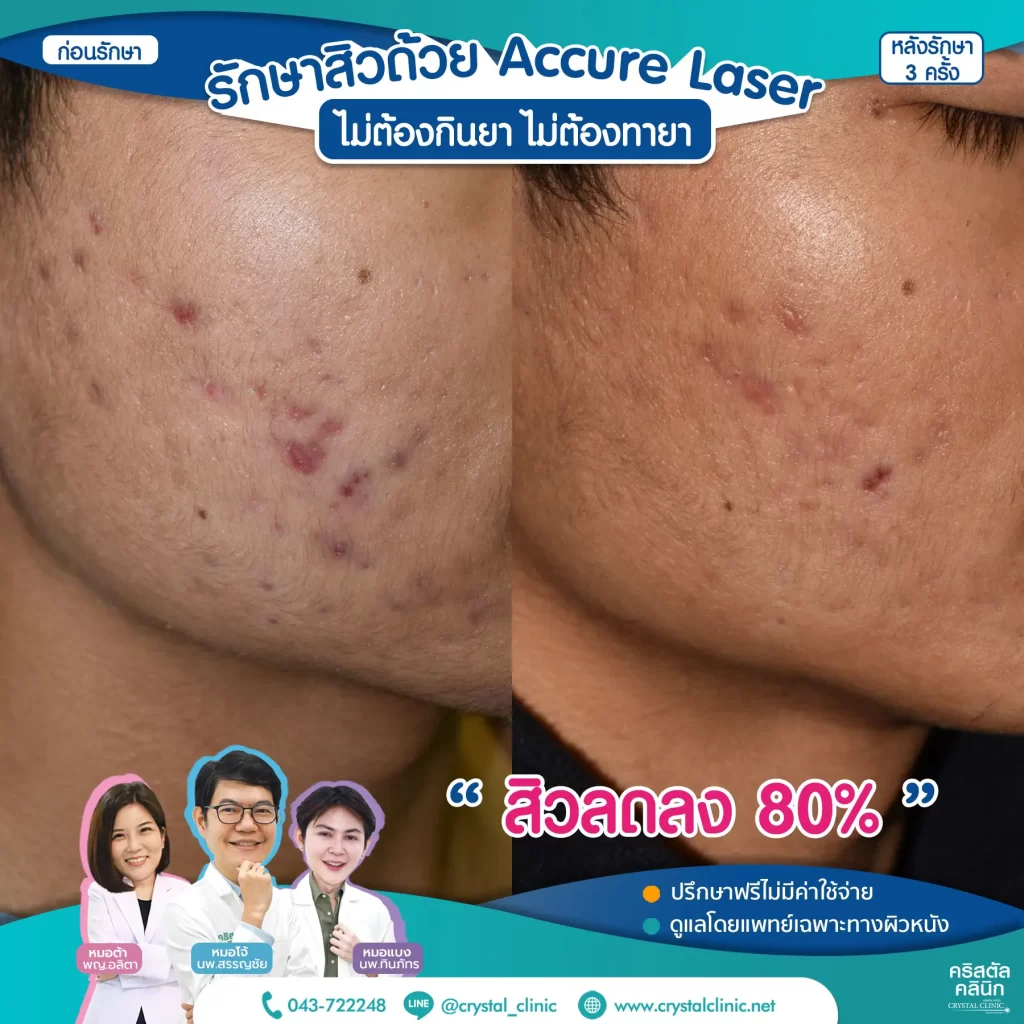 6709257-Accure-Laser-หลังทำ-3-ครั้ง_1-1024x1024