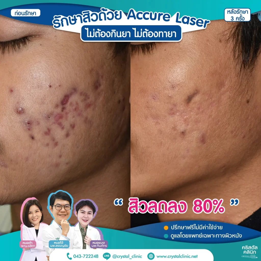 6709257-Accure-Laser-หลังทำ-3-ครั้ง_2-1024x1024