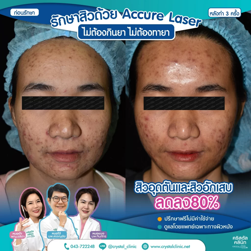 6710176_Accure-Laser-หลังทำ-3-ครั้ง_1-1024x1024