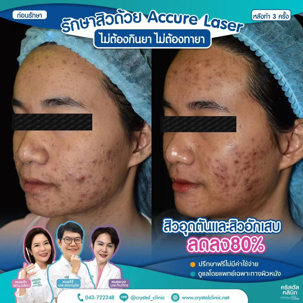 6710176_Accure-Laser-หลังทำ-3-ครั้ง_2-1024x1024