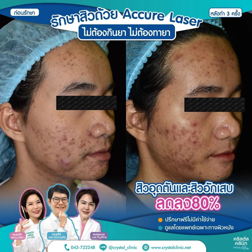 6710176_Accure-Laser-หลังทำ-3-ครั้ง_3-1024x1024
