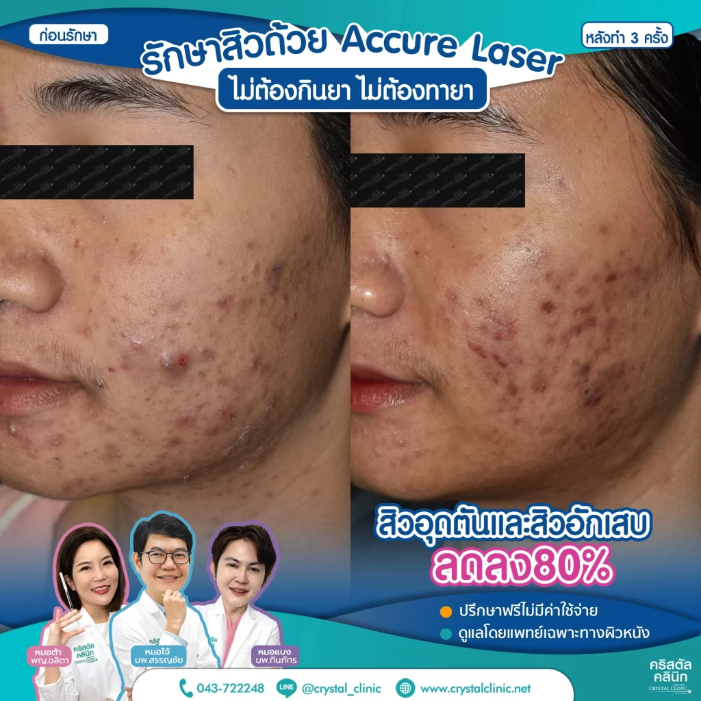 6710176_Accure-Laser-หลังทำ-3-ครั้ง_4-1024x1024