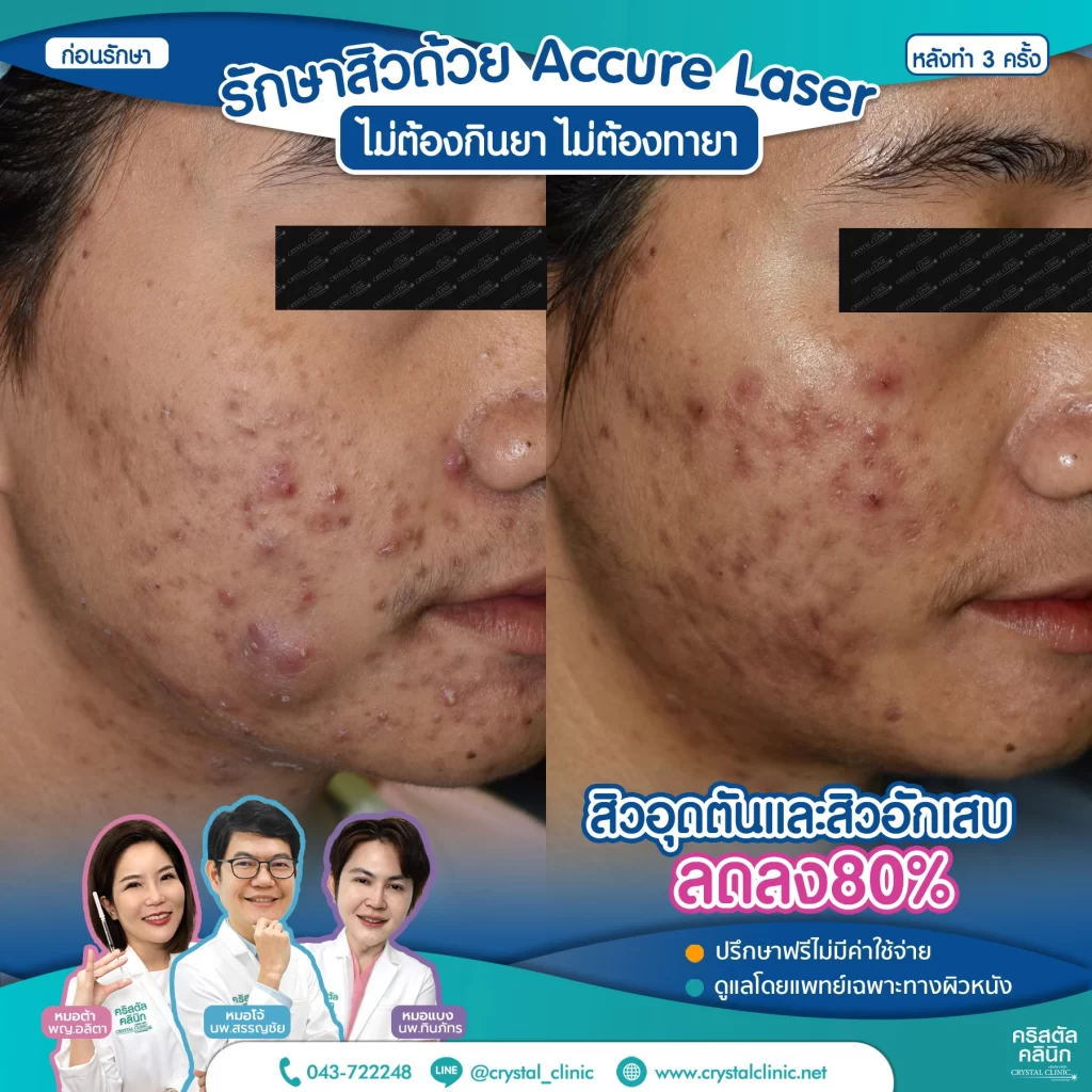 6710176_Accure-Laser-หลังทำ-3-ครั้ง_5-1024x1024
