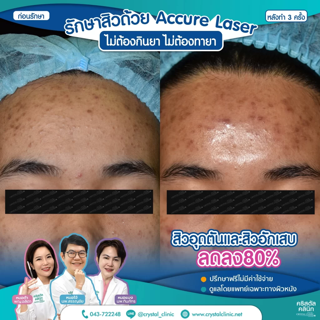 6710176_Accure-Laser-หลังทำ-3-ครั้ง_6-1024x1024