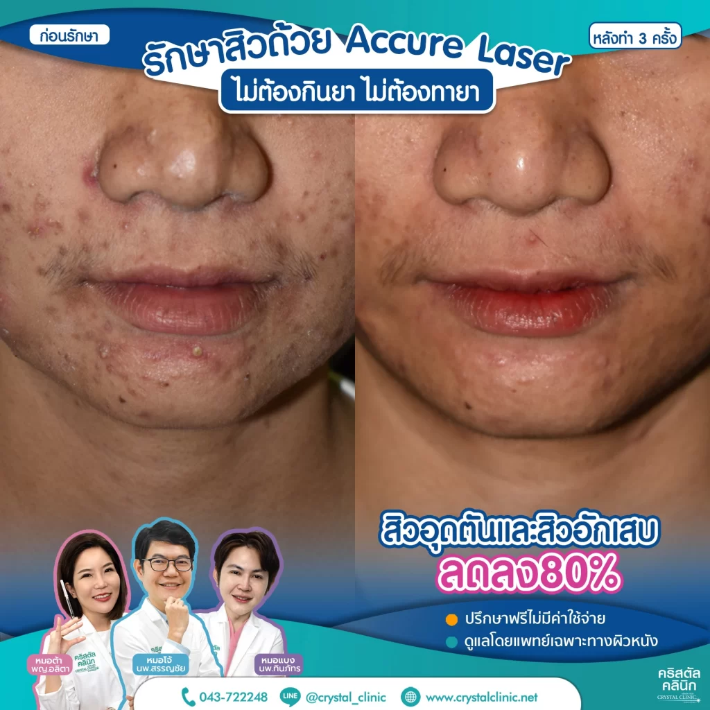 6710176_Accure-Laser-หลังทำ-3-ครั้ง_7-1024x1024