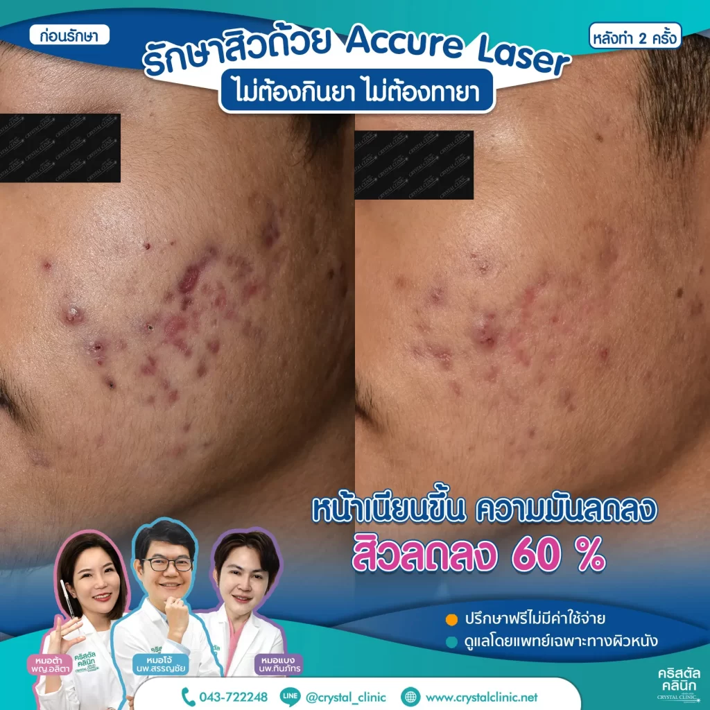 Accure-Laser-review-After-2-month-1-1024x1024