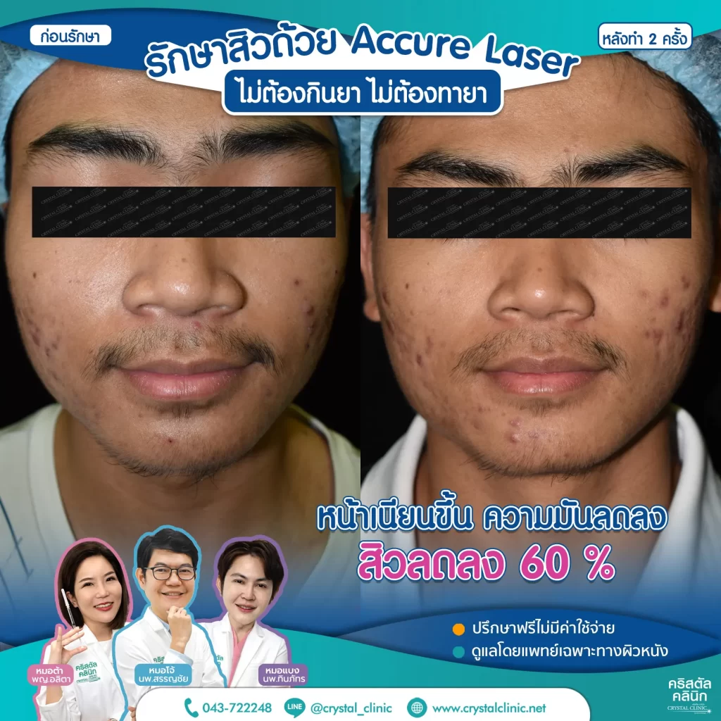 Accure-Laser-review-After-2-month-2-1024x1024