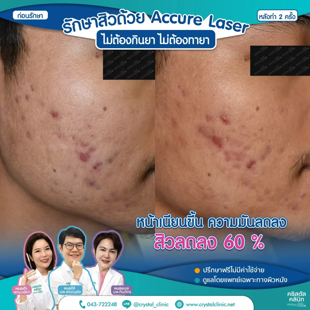 Accure-Laser-review-After-2-month-3-1024x1024
