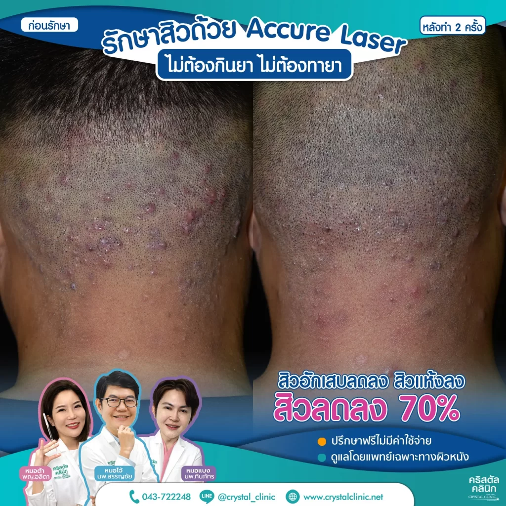 Accure-Laser-review-หลังทำ-2-ครั้ง-1-1024x1024