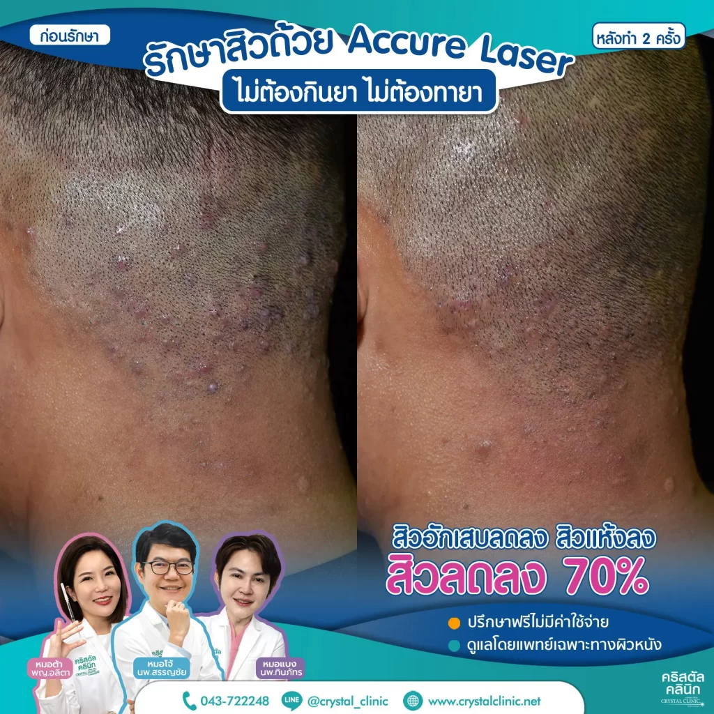 Accure-Laser-review-หลังทำ-2-ครั้ง-2-1024x1024