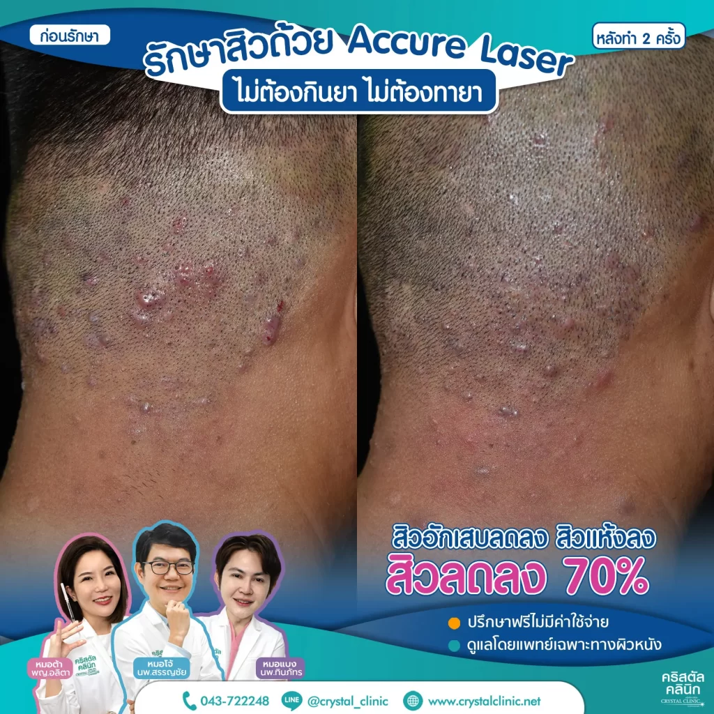 Accure-Laser-review-หลังทำ-2-ครั้ง-3-1024x1024