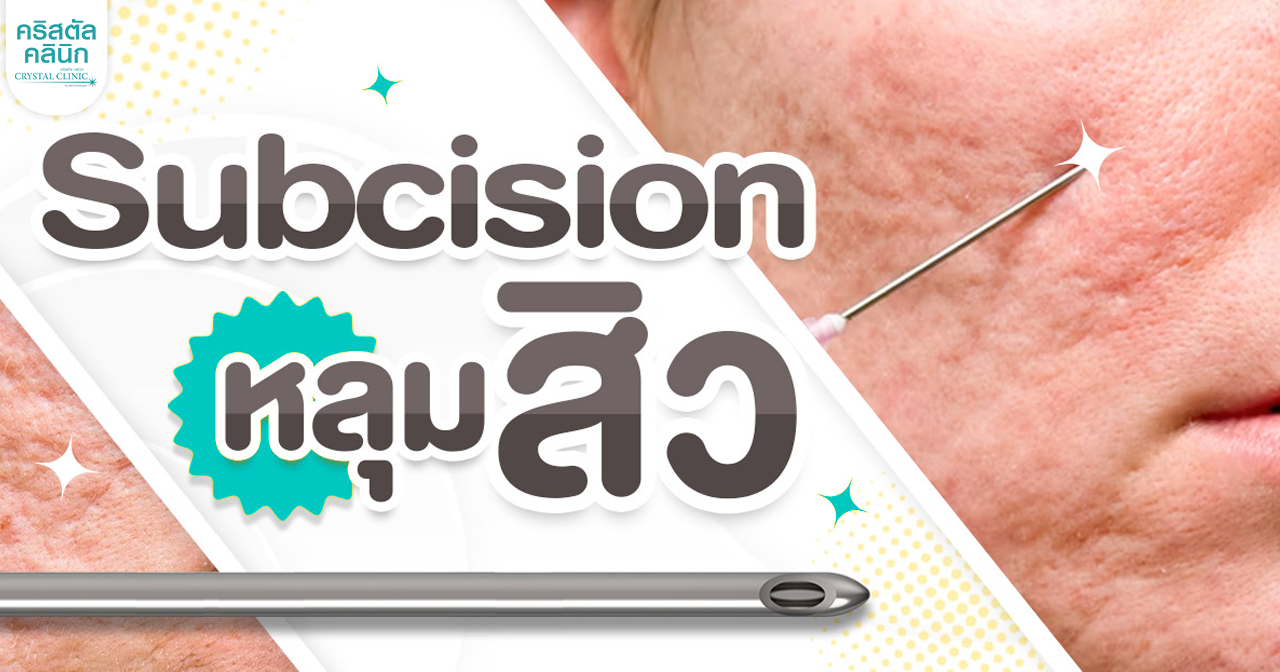 ปก ตัดพังผืดหลุมสิว Subcision คืออะไร คริสตัลคลินิกมหาสารคาม
