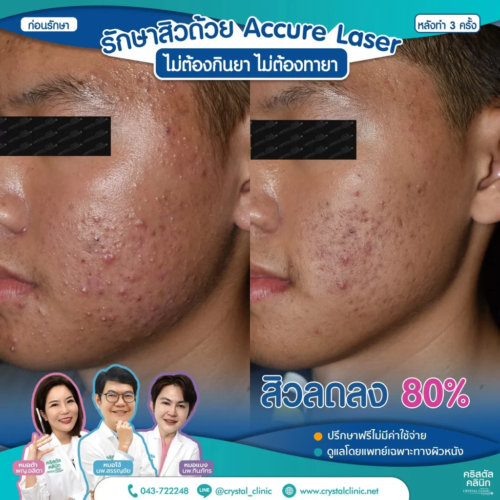 รีวิว-หลังรักษาสิว-ด้วย-Accure-Laser-3-ครั้ง-1-1024x1024