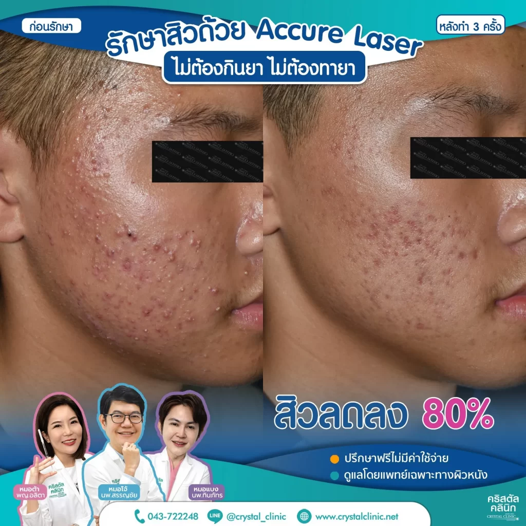 รีวิว-หลังรักษาสิว-ด้วย-Accure-Laser-3-ครั้ง-2-1024x1024