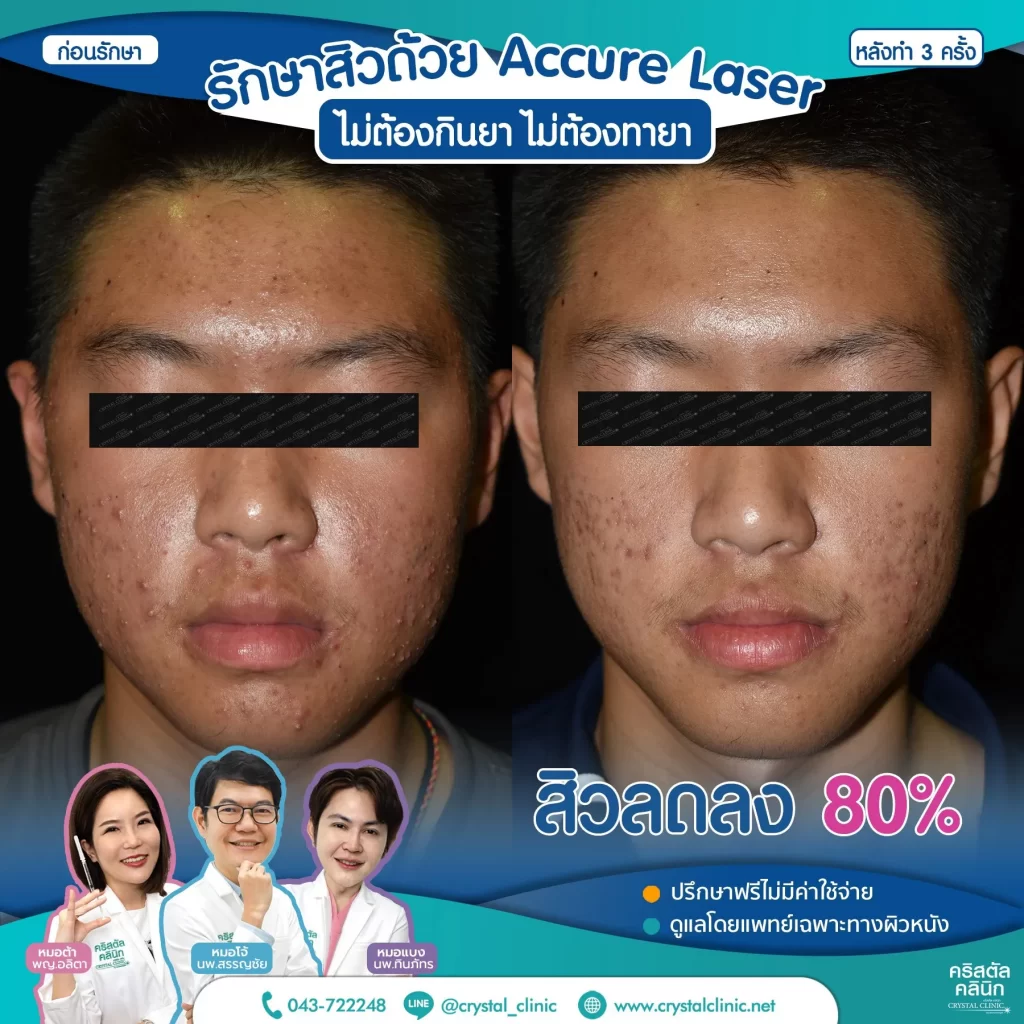 รีวิว-หลังรักษาสิว-ด้วย-Accure-Laser-3-ครั้ง-3-1024x1024
