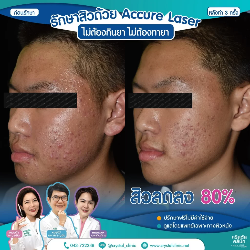 รีวิว-หลังรักษาสิว-ด้วย-Accure-Laser-3-ครั้ง-4-1024x1024