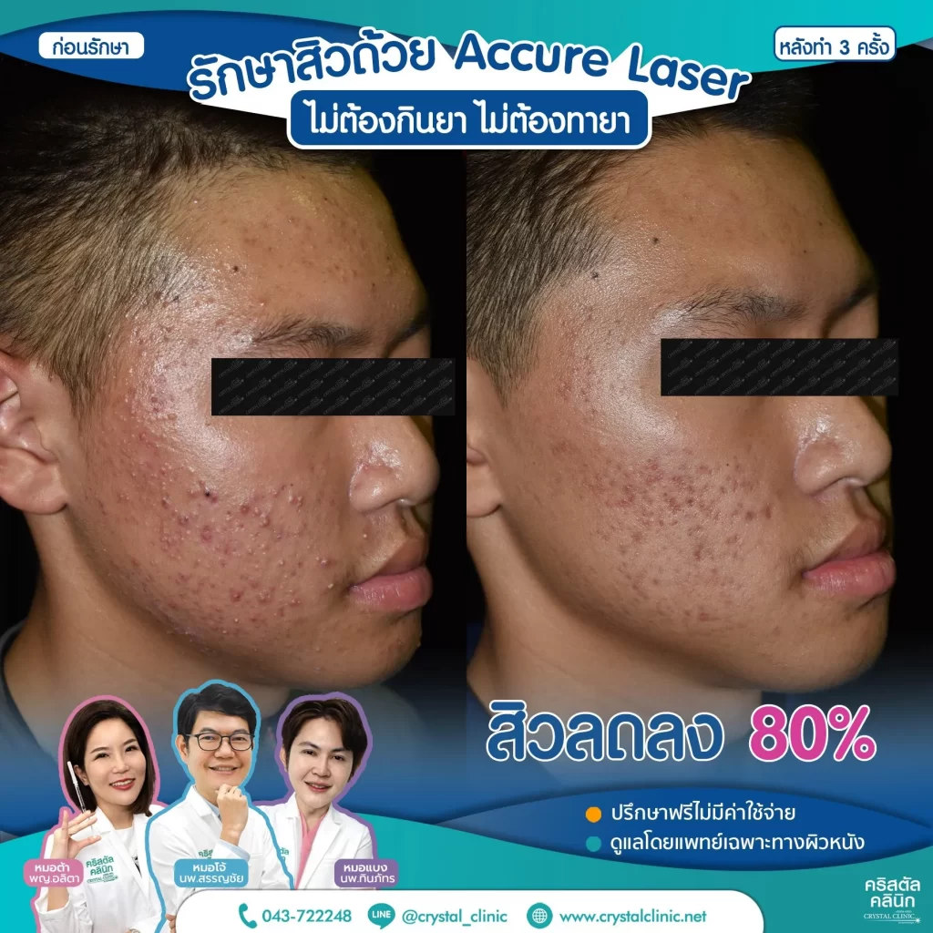 รีวิว-หลังรักษาสิว-ด้วย-Accure-Laser-3-ครั้ง-5-1024x1024