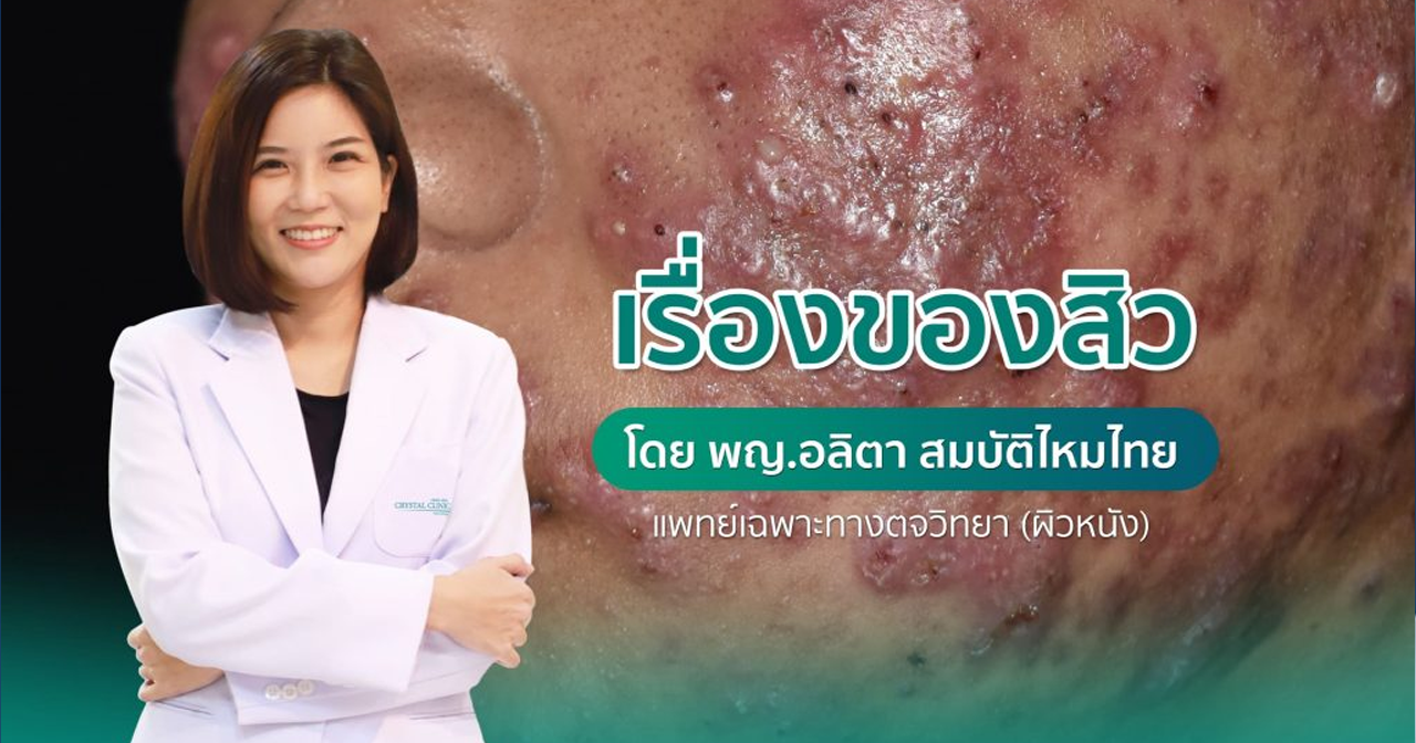 สาเหตุการเกิดสิว (Acne) สิวเกิดจากอะไร วิธีรักษาสิว โดย พญ. อลิตา สมบัติไหมไทย (แพทย์เฉพาะทางผิวหนัง ประจำคริสตัลคลินิก มหาสารคาม)