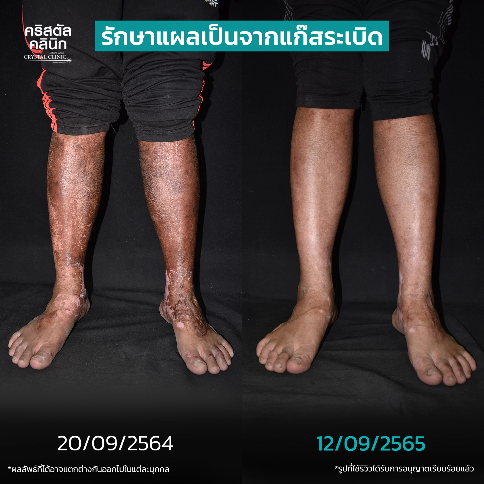 รักษาแผลเป็นจากแก๊สระเบิด รักษาแผลเป็นจากแก๊สระเบิด