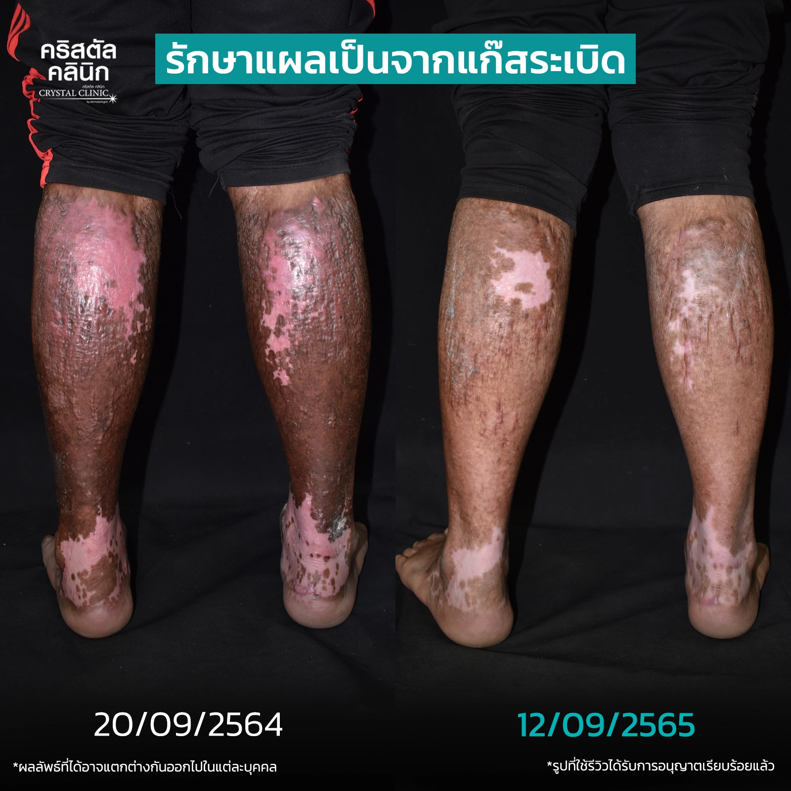 รักษาแผลเป็นจากแก๊สระเบิด รักษาแผลเป็นจากแก๊สระเบิด