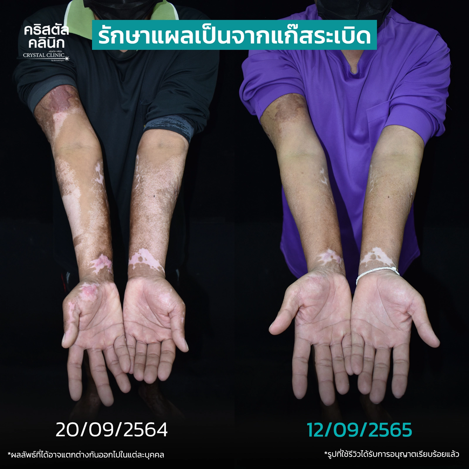 รักษาแผลเป็นจากแก๊สระเบิด รักษาแผลเป็นจากแก๊สระเบิด
