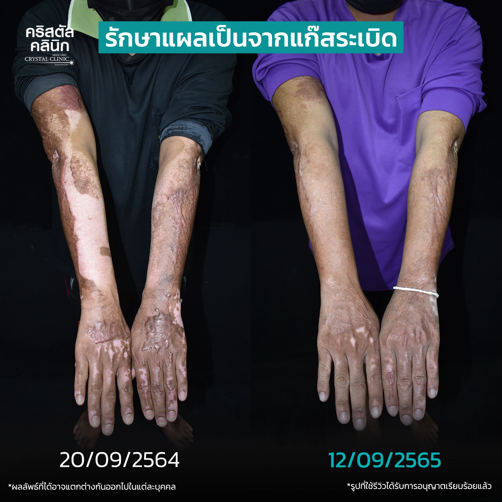รักษาแผลเป็นจากแก๊สระเบิด รักษาแผลเป็นจากแก๊สระเบิด