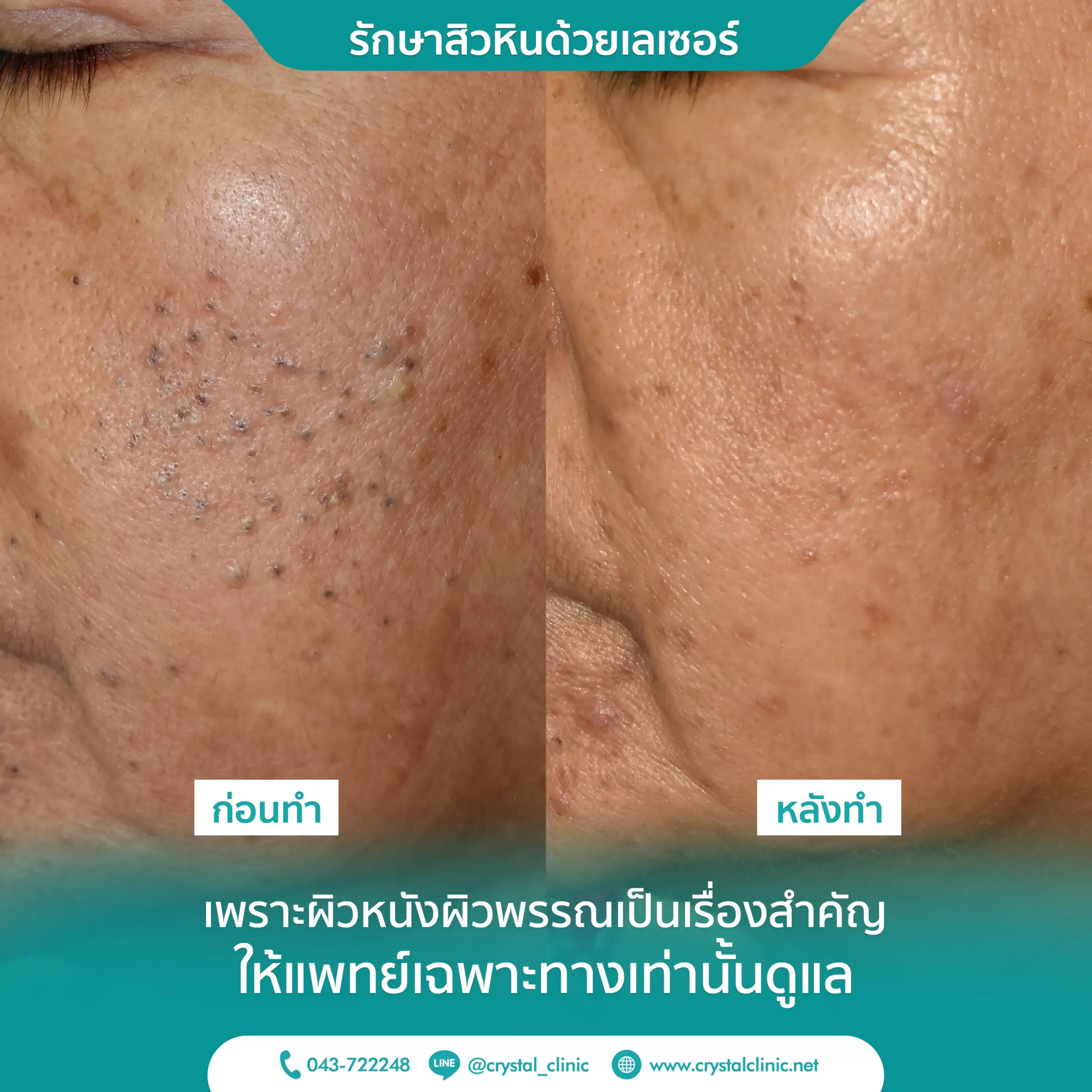 ภาพรีวิวรักษาสิวหิน คริสตัลคลินิก มหาสารคาม ภาพรีวิวรักษาสิวหิน คริสตัลคลินิก มหาสารคาม