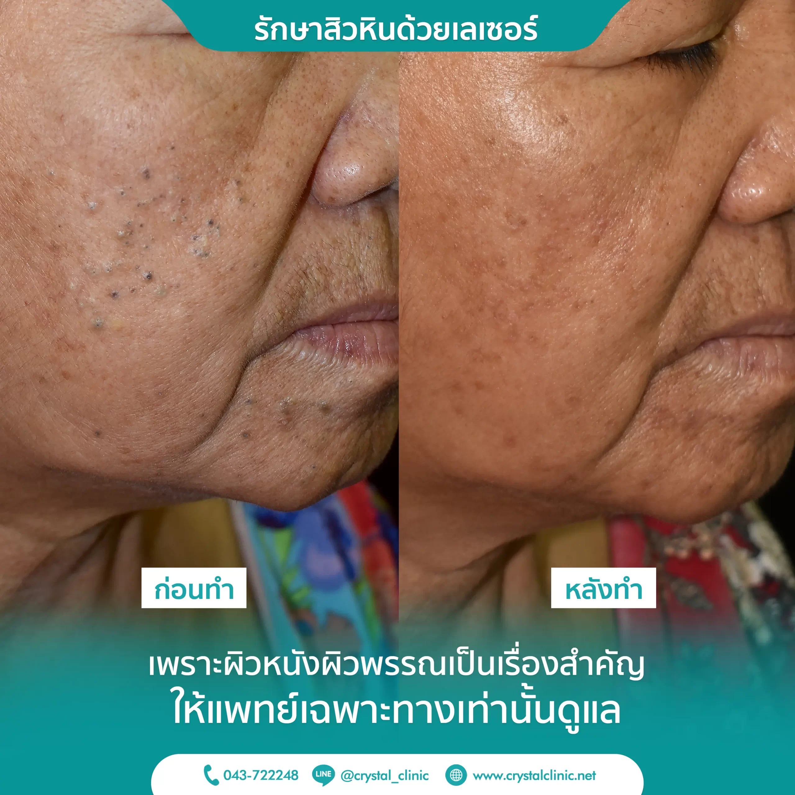 CO2-Laser-รักษาสิวหิน-คริสตัลคลินิก-มหาสารคาม-1 CO2-Laser-รักษาสิวหิน-คริสตัลคลินิก-มหาสารคาม-1