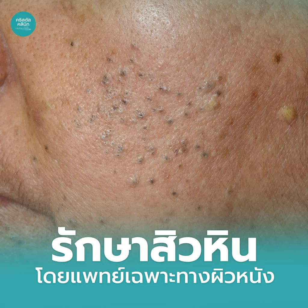 สิวหินคืออะไร-รักษาสิวหิน-ด้วย-CO2-Laser
